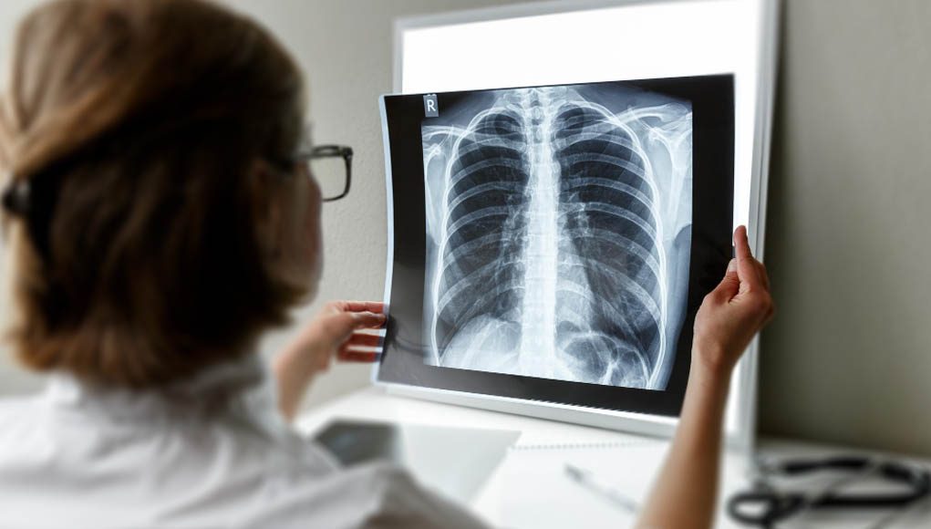 Marruecos: 53 % de los casos de tuberculosis son extrapulmonares